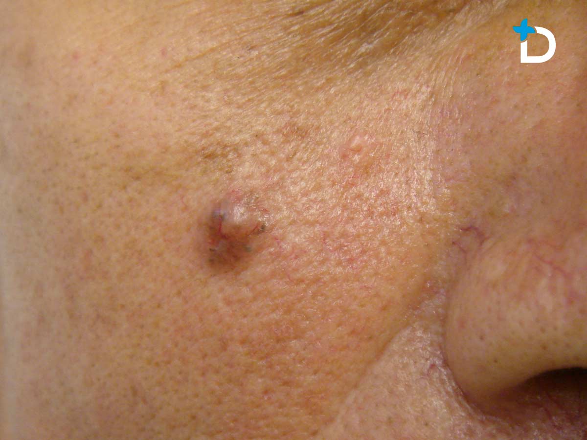 CARCINOMA BASOCELULAR