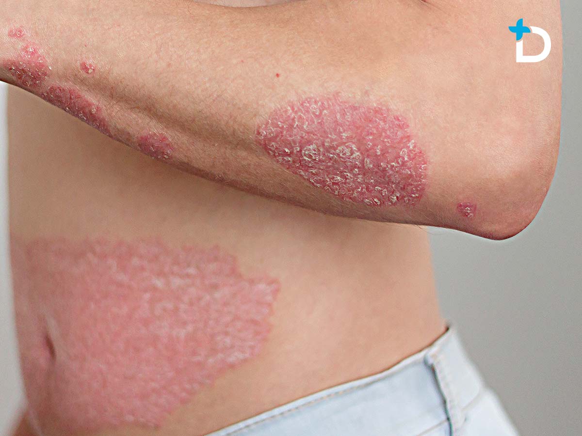 Tratamiento para la psoriasis