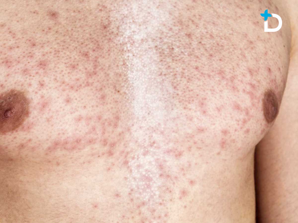 Urticaria