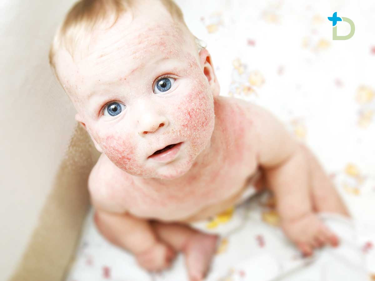 Dermatitis Infantil