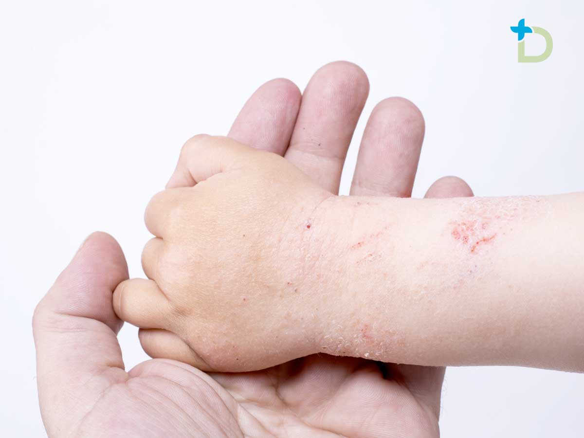 Dermatitis Infantil