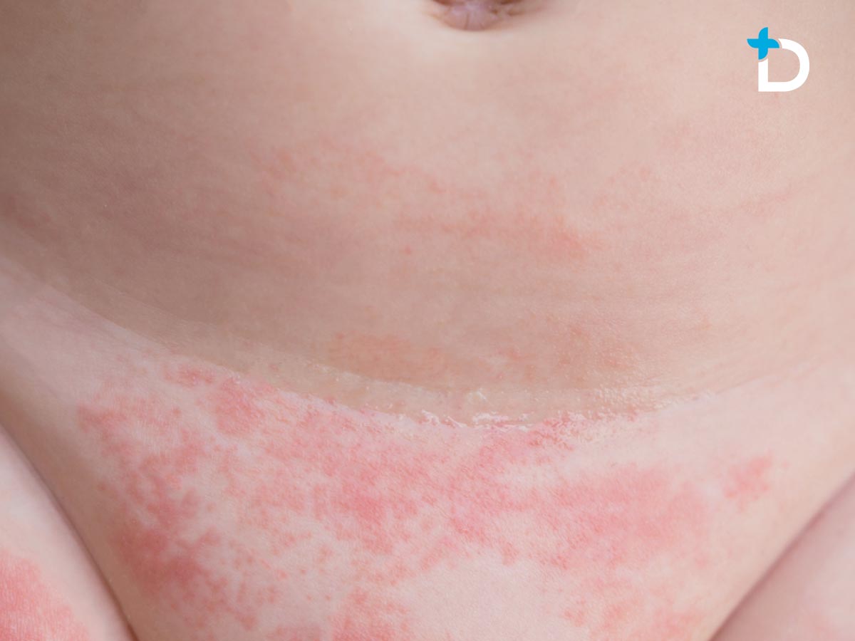 Dermatitis del área del pañal