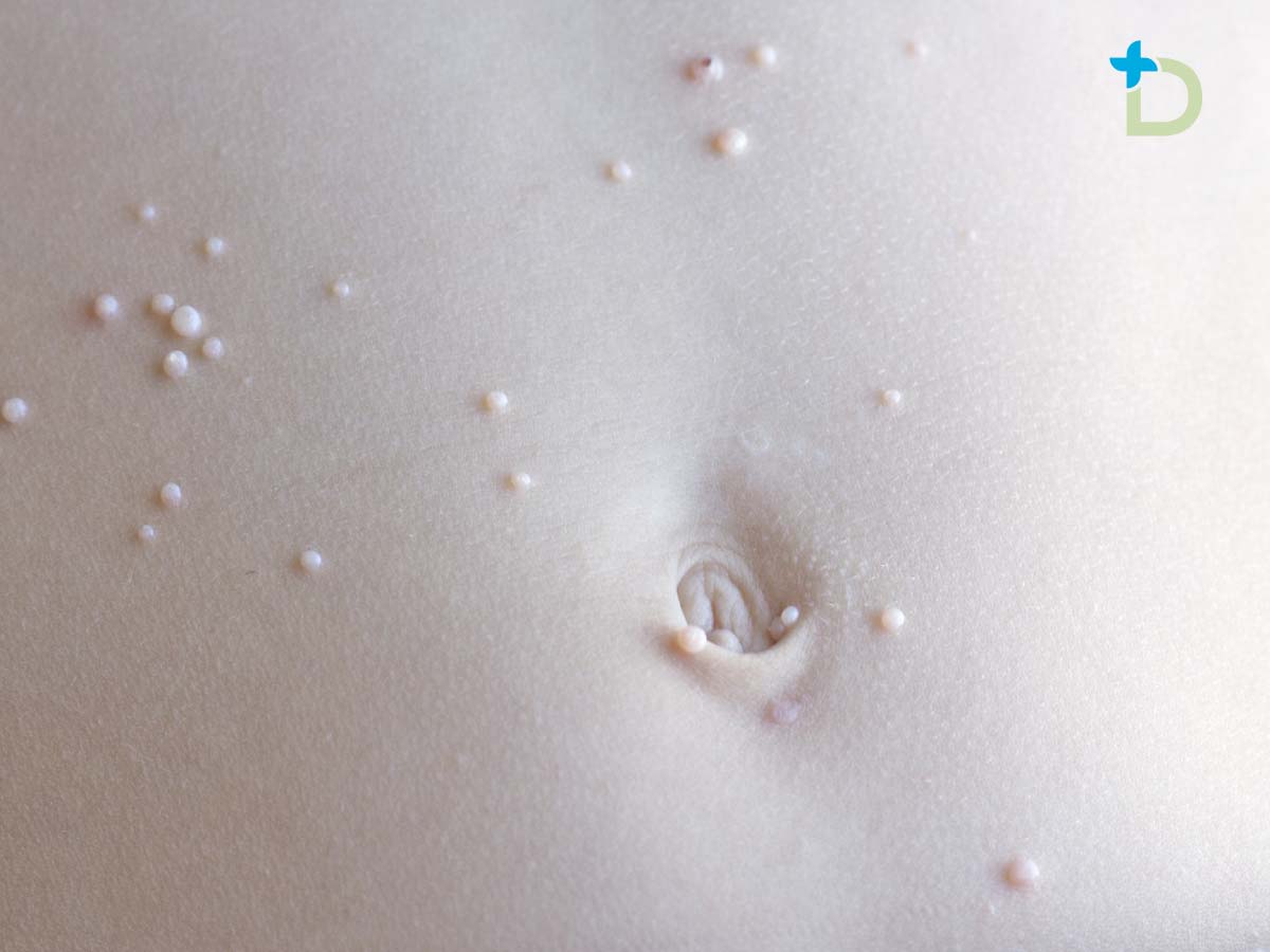 Molusco Contagioso