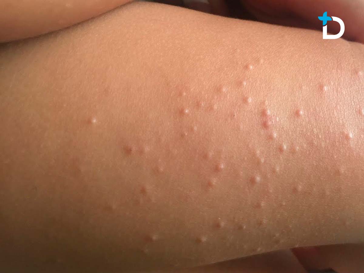 Molusco Contagioso