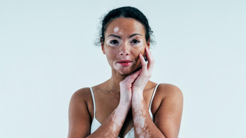 Vitiligo