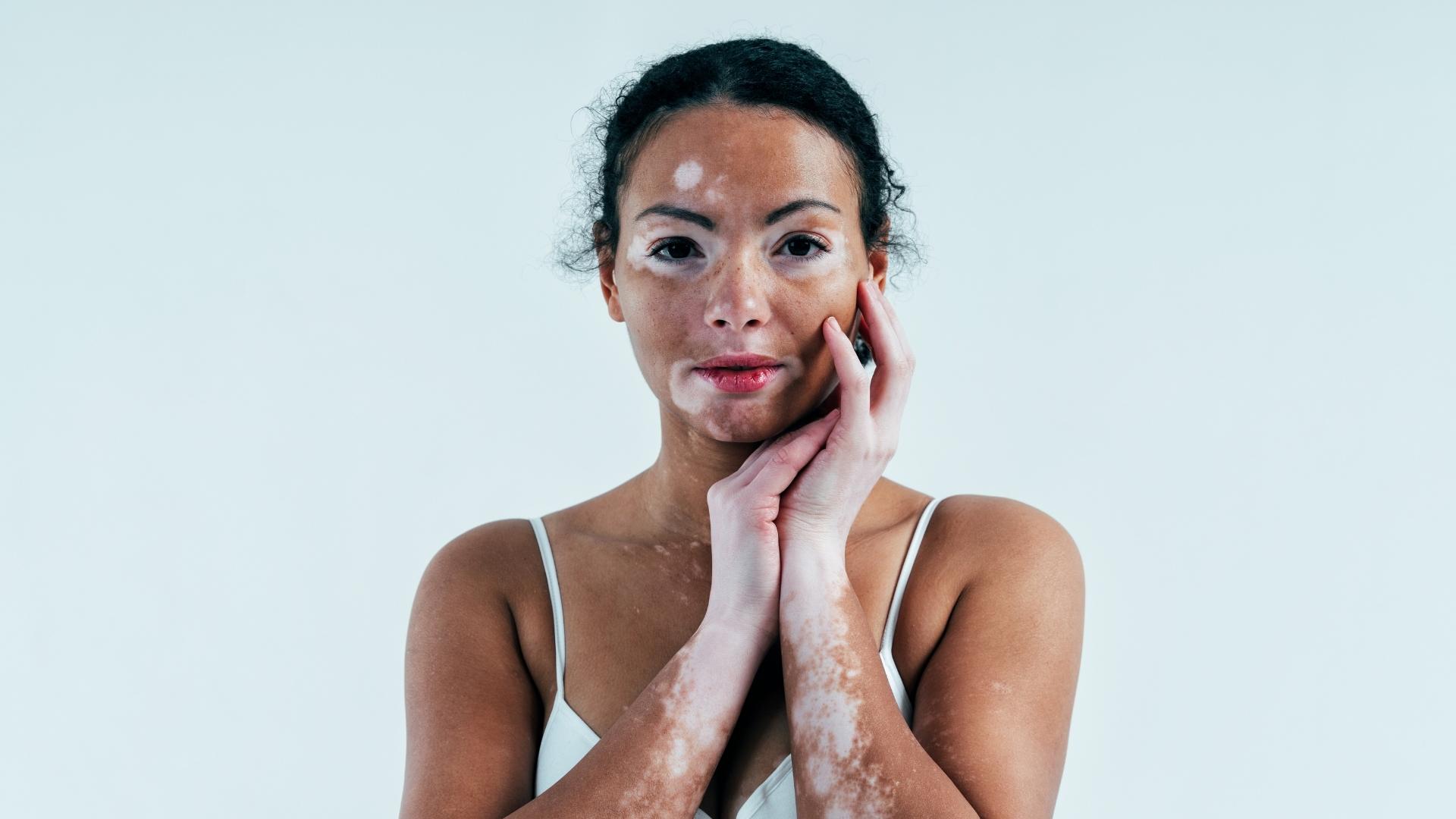 Vitiligo