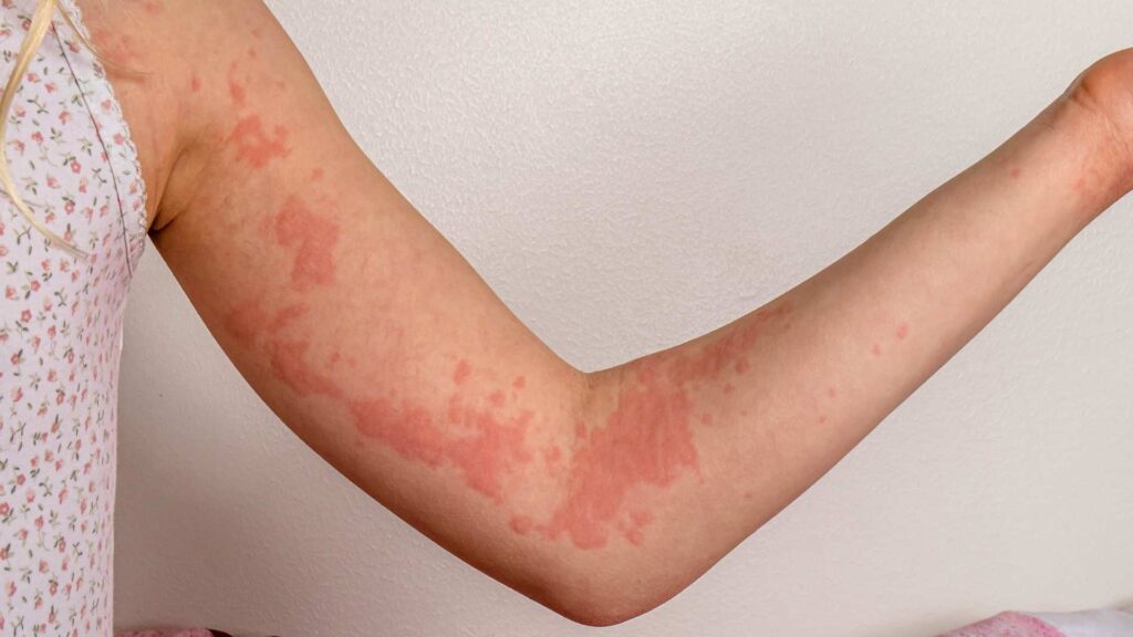 Urticaria