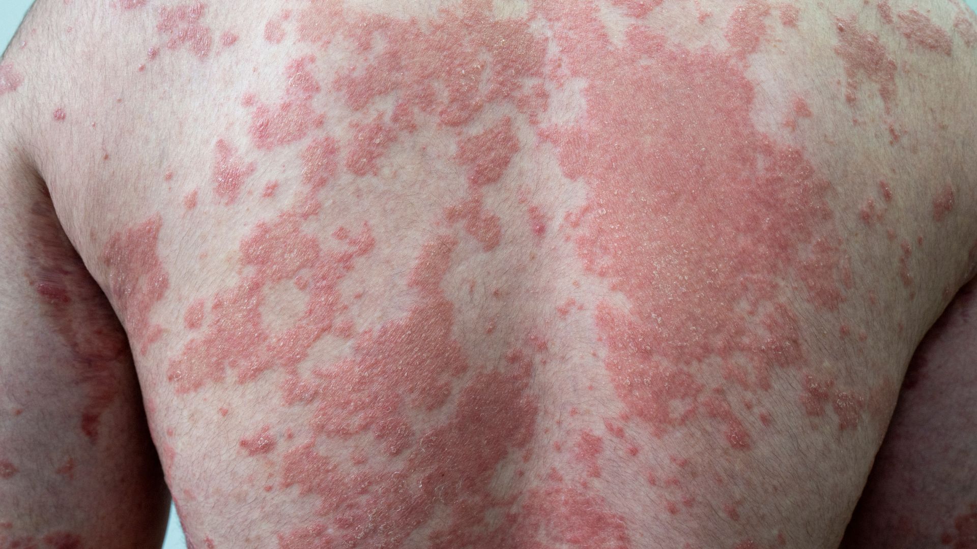 Psoriasis