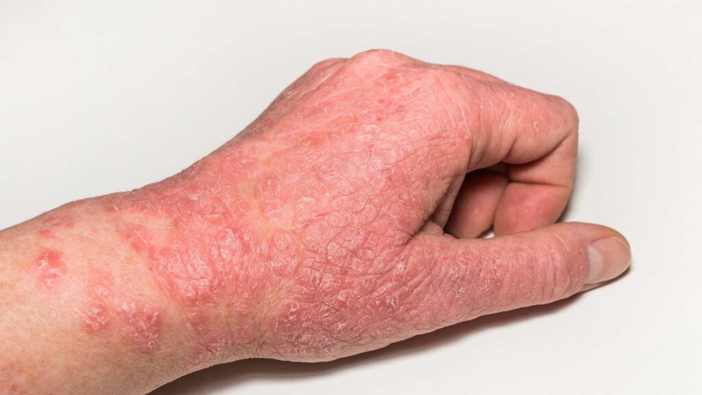 Dermatitis Atópica