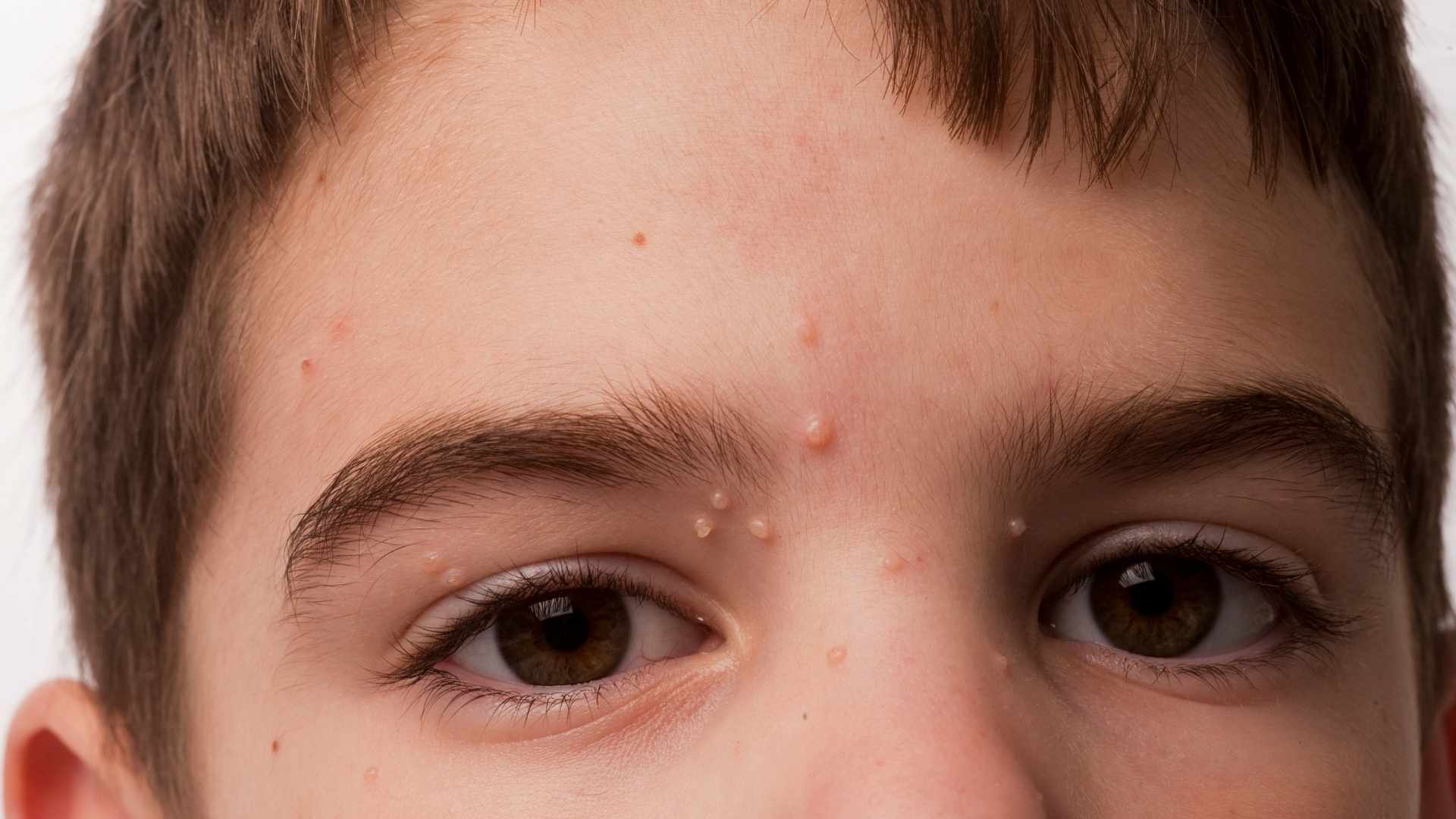 Molusco Contagioso