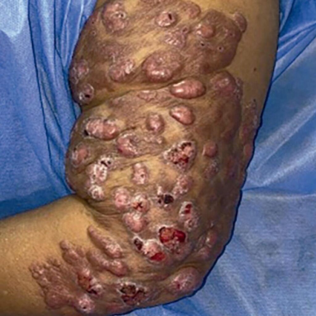 Lobomicosis. Placa tumoral en el brazo izquierdo.